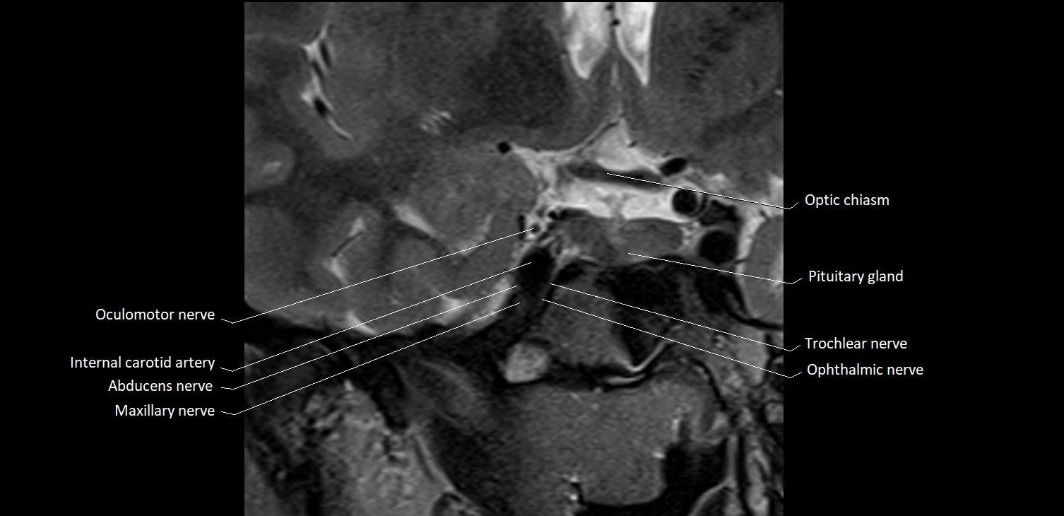 MRI Orbit coronal cross sectional anatomy image 22.webp